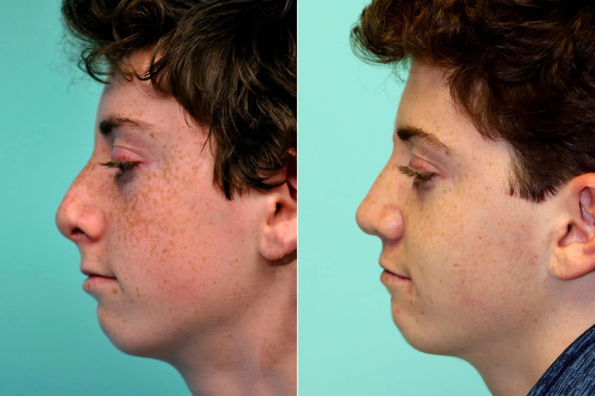 Before and after Rhinoplasty by Dr. Shervin Naderi, Patient 17592