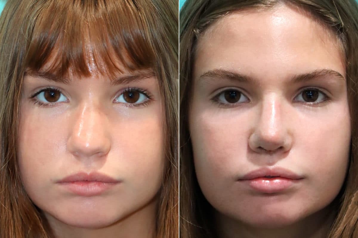 Before and after Rhinoplasty by Dr. Shervin Naderi, Patient 17630