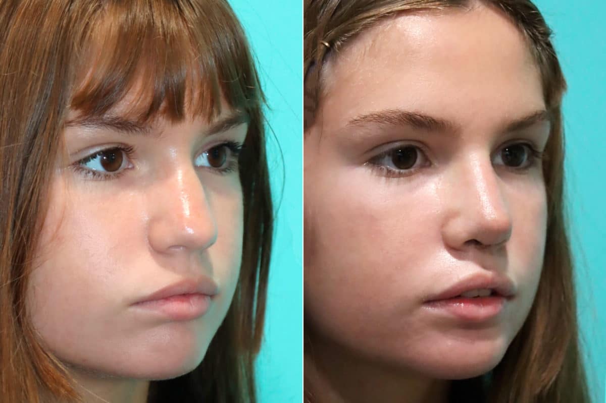 Before and after Rhinoplasty by Dr. Shervin Naderi, Patient 17630