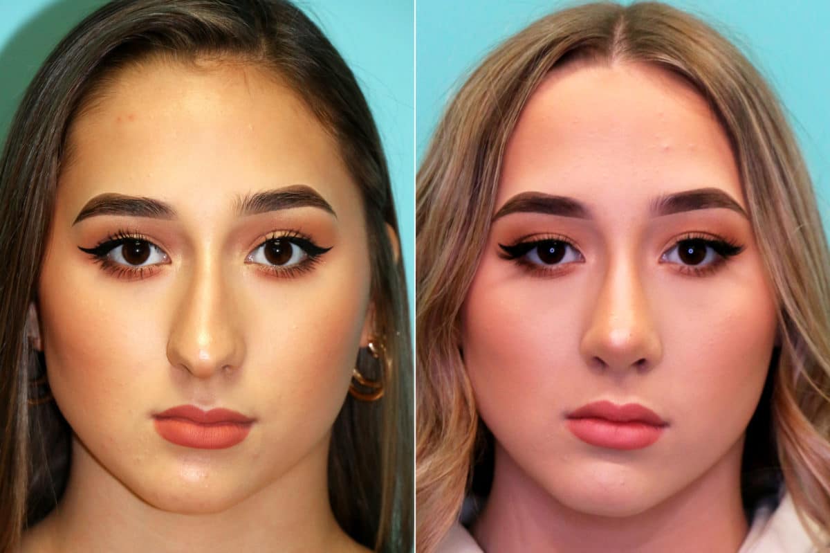 Before and after Rhinoplasty by Dr. Shervin Naderi, Patient 17661