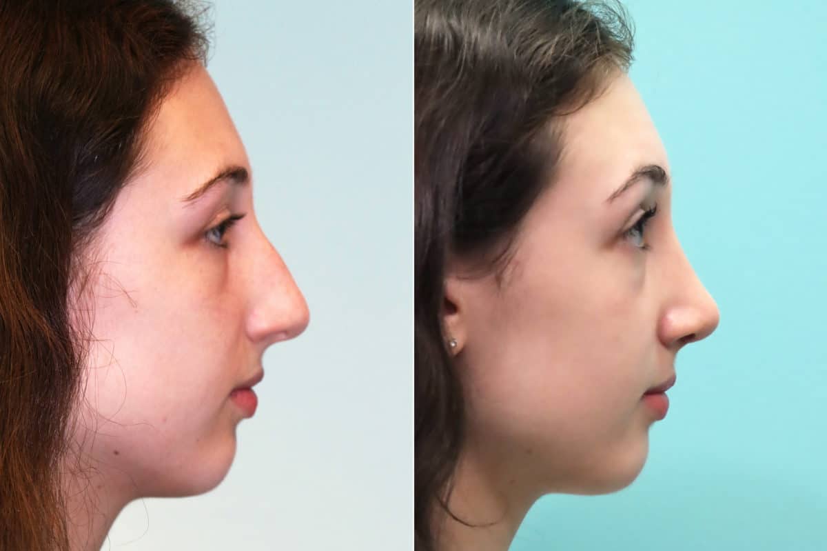 Before and after Rhinoplasty by Dr. Shervin Naderi, Patient 17549