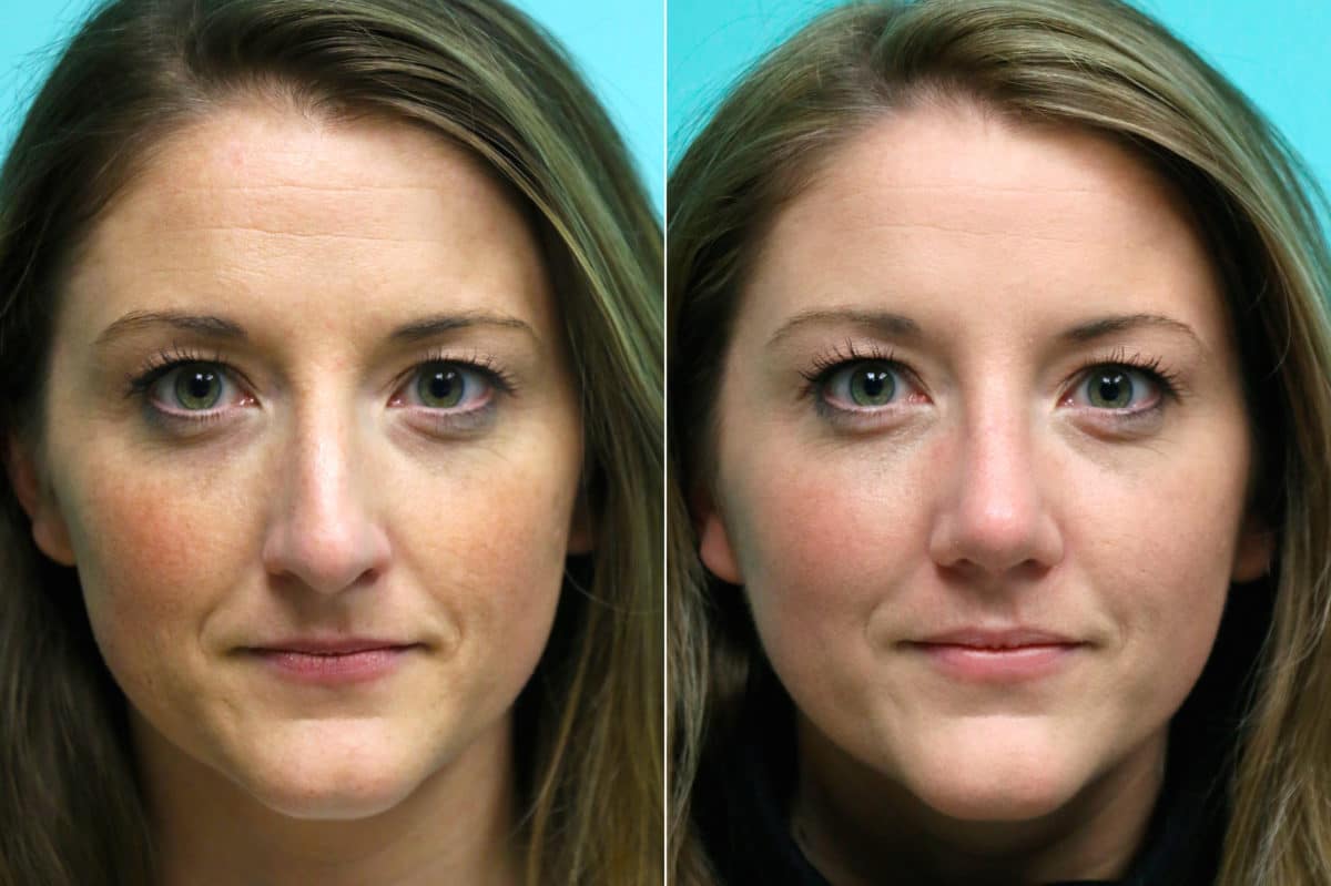 Before and after Rhinoplasty by Dr. Shervin Naderi, Patient 17660