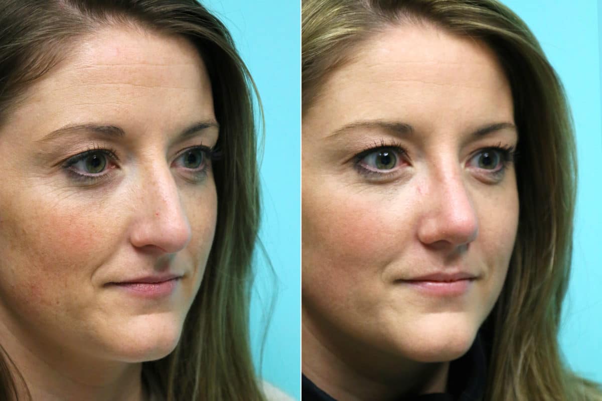 Before and after Rhinoplasty by Dr. Shervin Naderi, Patient 17660