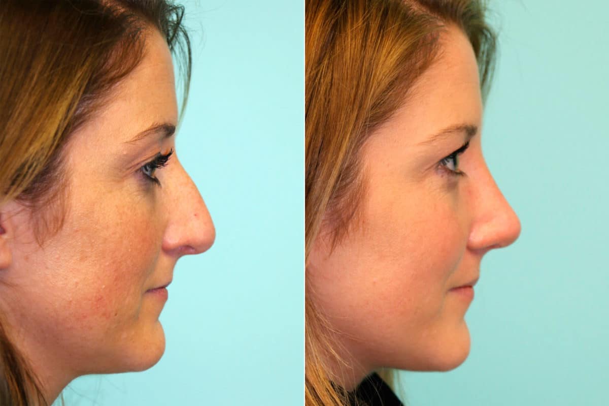 Before and after Rhinoplasty by Dr. Shervin Naderi, Patient 17660