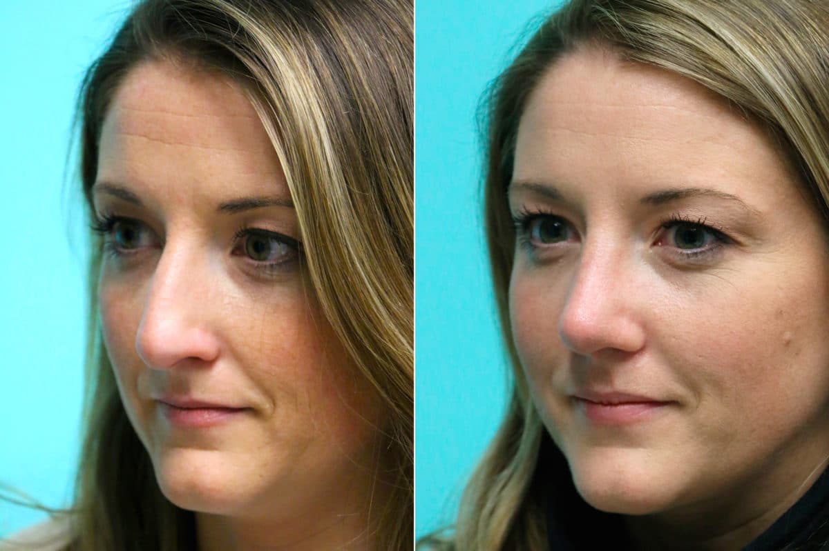 Before and after Rhinoplasty by Dr. Shervin Naderi, Patient 17660