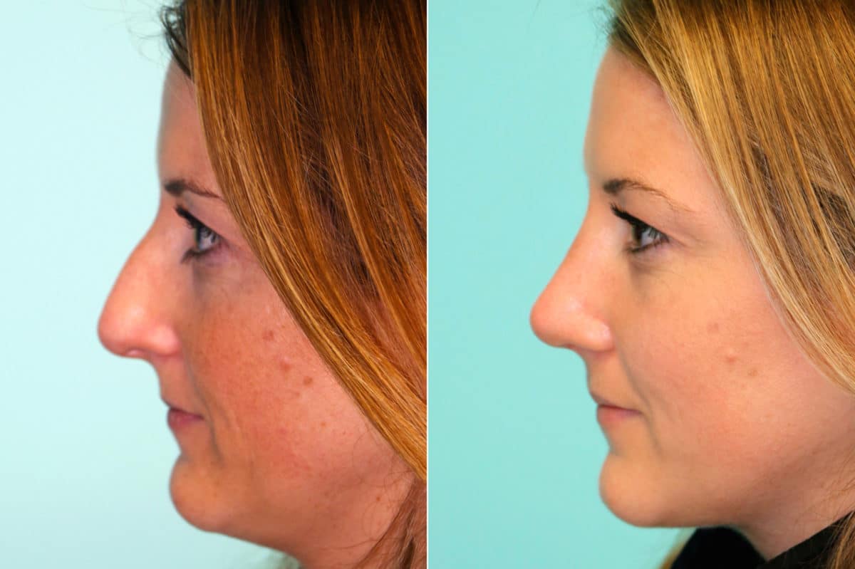 Before and after Rhinoplasty by Dr. Shervin Naderi, Patient 17660