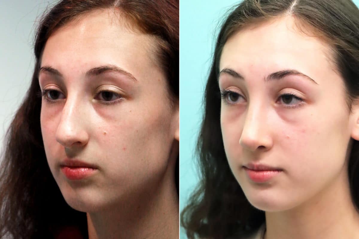 Before and after Rhinoplasty by Dr. Shervin Naderi, Patient 17549