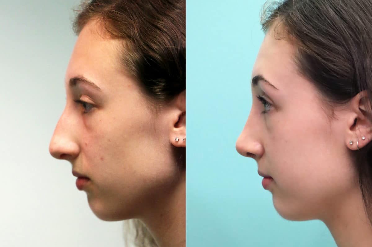 Before and after Rhinoplasty by Dr. Shervin Naderi, Patient 17549