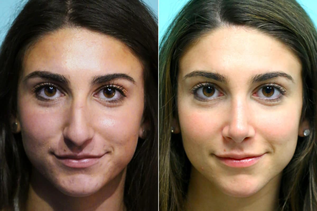 Before and after Rhinoplasty by Dr. Shervin Naderi, Patient 17572