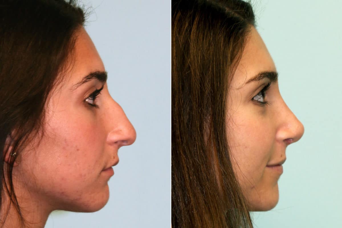 Before and after Rhinoplasty by Dr. Shervin Naderi, Patient 17572