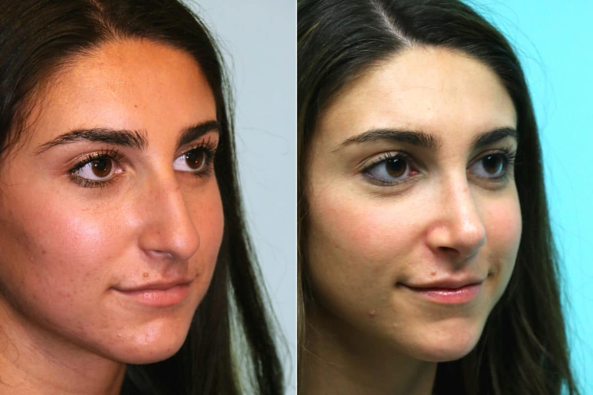 Before and after Rhinoplasty by Dr. Shervin Naderi, Patient 17572