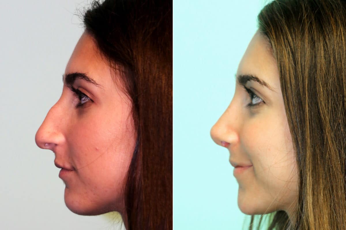 Before and after Rhinoplasty by Dr. Shervin Naderi, Patient 17572