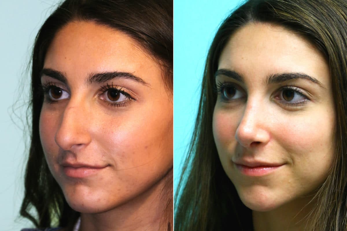 Before and after Rhinoplasty by Dr. Shervin Naderi, Patient 17572