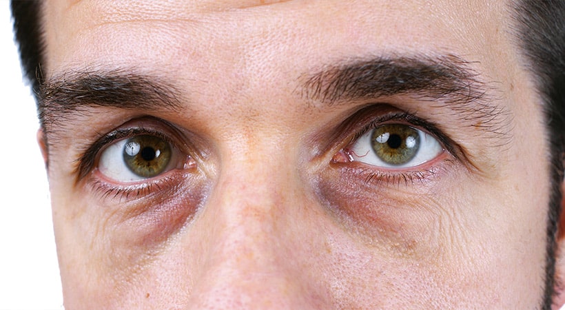 Tear trough deformities result in a hollowed-out and sunken appearance of the eyes.