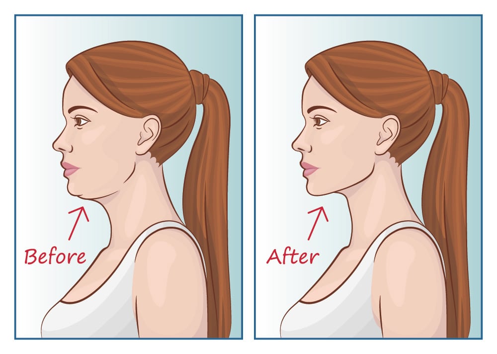 Jawline Contouring In Virginia Washington D C Maryland