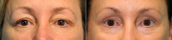 Before and after Blepharoplasty by Dr. Shervin Naderi, Patient 17812