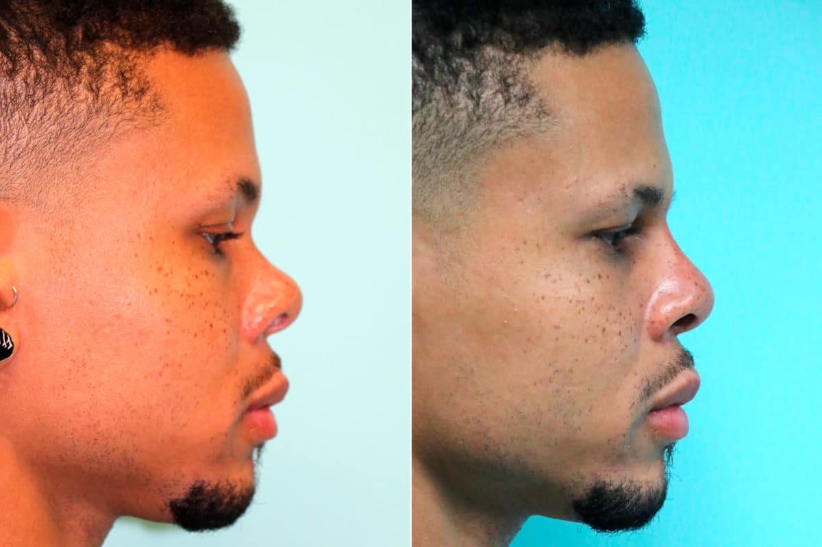 Before and after Non-Surgical Rhinoplasty by Dr. Shervin Naderi, Patient 17817