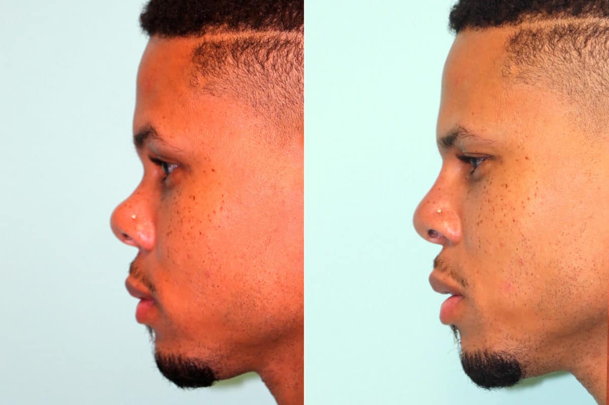 Before and after Non-Surgical Rhinoplasty by Dr. Shervin Naderi, Patient 17817