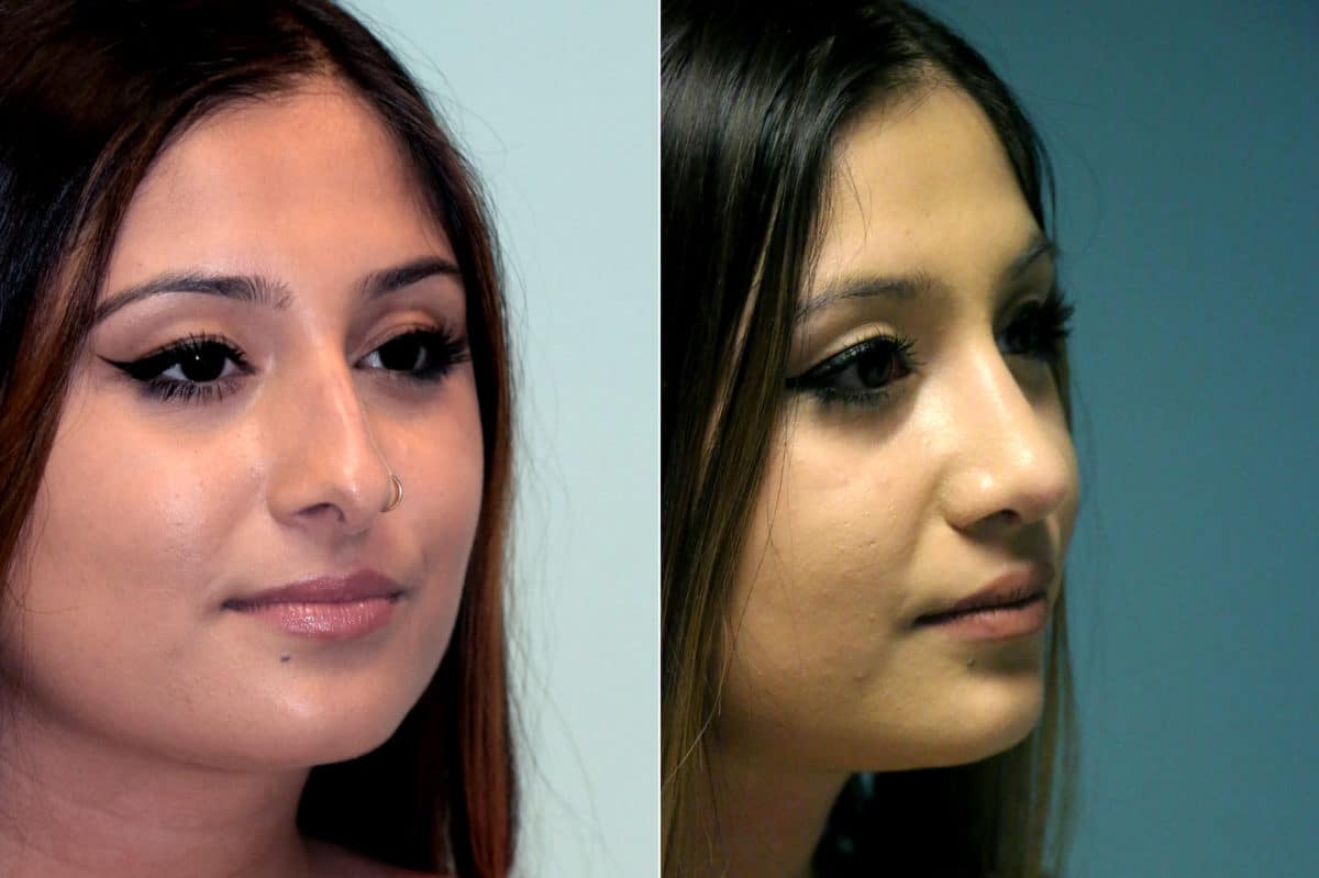 Before and after Rhinoplasty by Dr. Shervin Naderi, Patient 18030