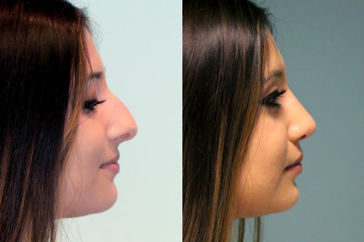 Before and after Rhinoplasty by Dr. Shervin Naderi, Patient 18030