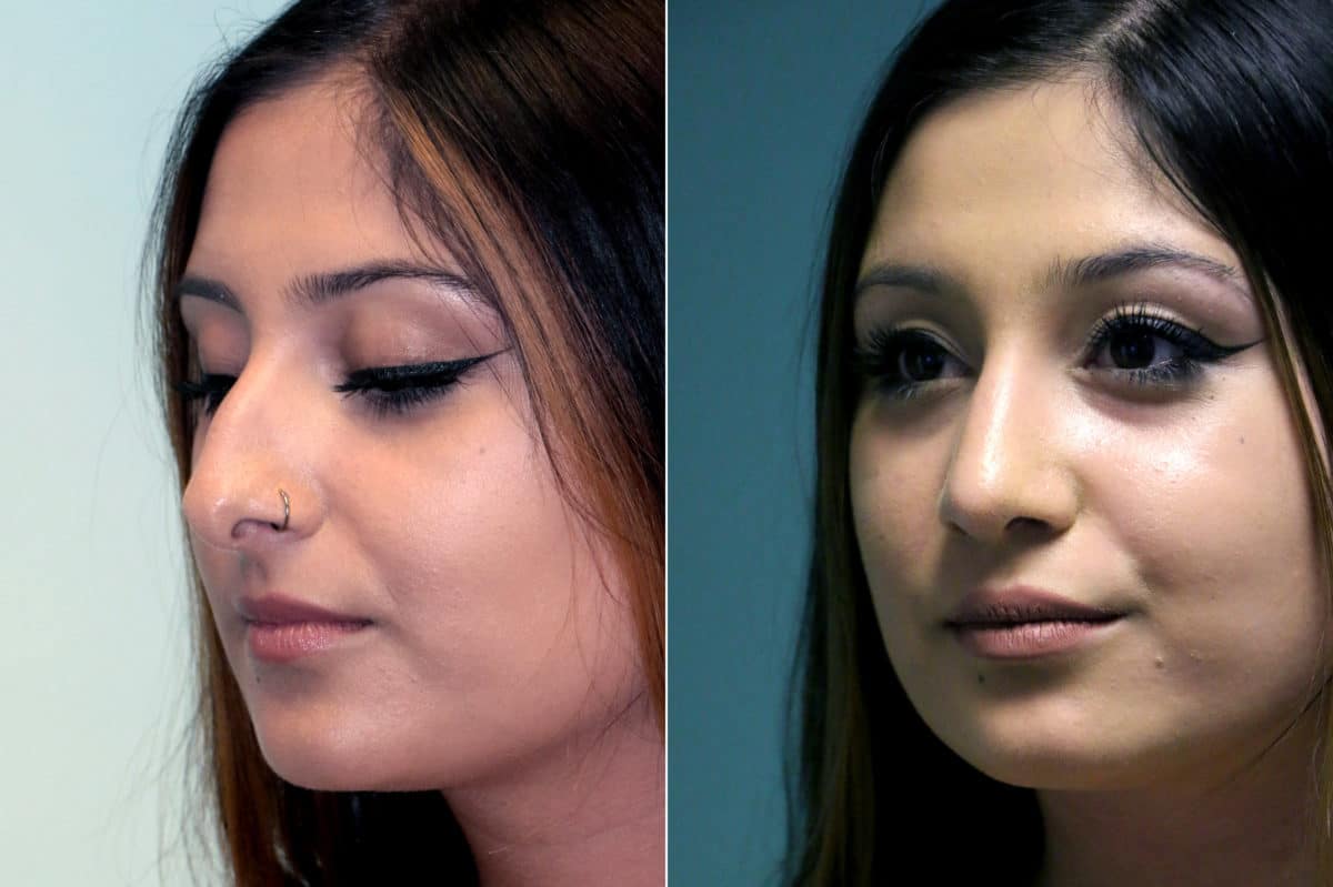 Before and after Rhinoplasty by Dr. Shervin Naderi, Patient 18030