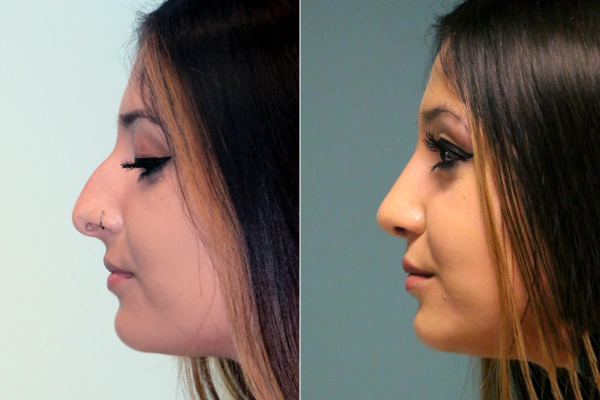 Before and after Rhinoplasty by Dr. Shervin Naderi, Patient 18030