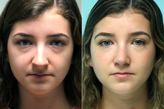 Before and after Rhinoplasty by Dr. Shervin Naderi, Patient 18046