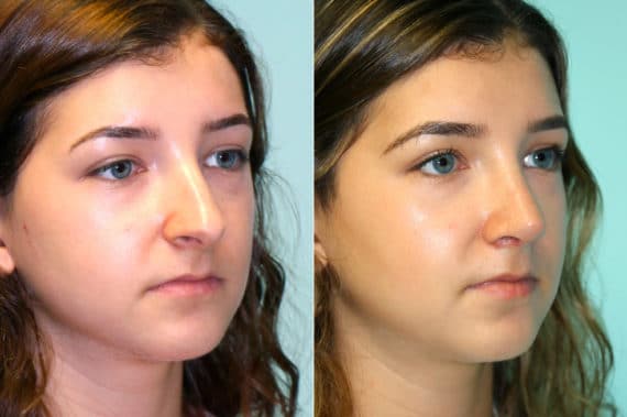 Before and after Rhinoplasty by Dr. Shervin Naderi, Patient 18046