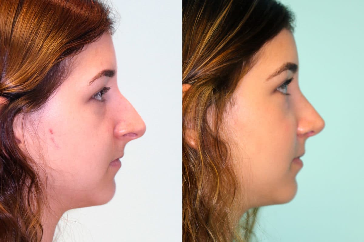 Before and after Rhinoplasty by Dr. Shervin Naderi, Patient 18046