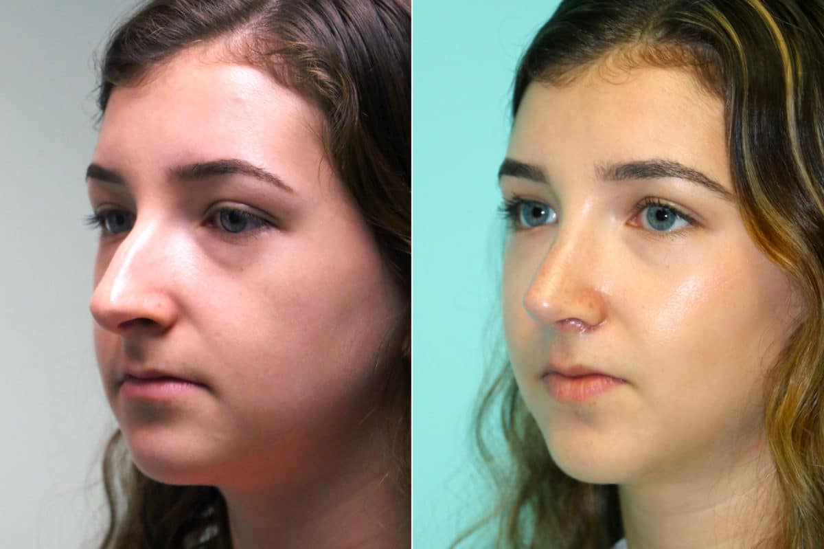 Before and after Rhinoplasty by Dr. Shervin Naderi, Patient 18046