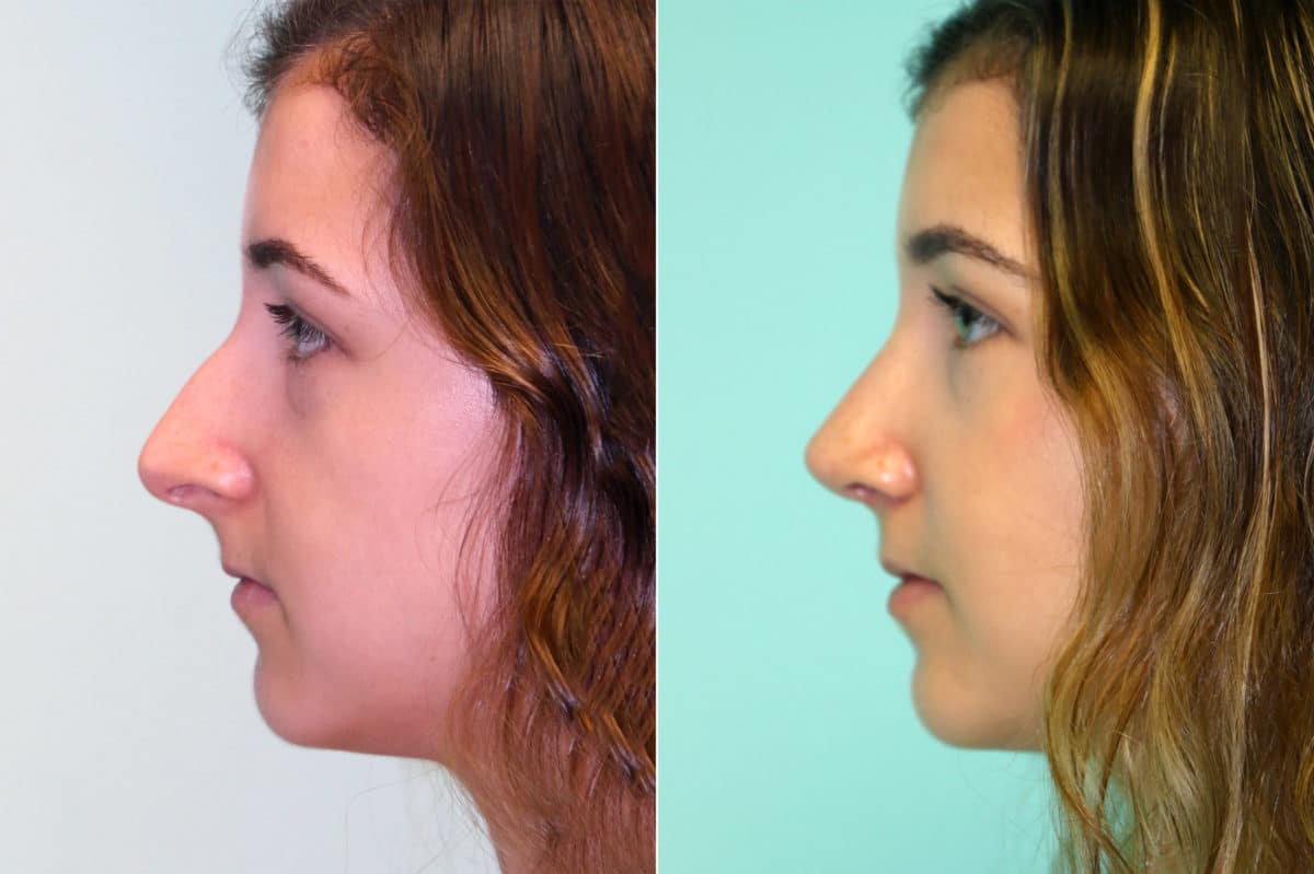 Before and after Rhinoplasty by Dr. Shervin Naderi, Patient 18046