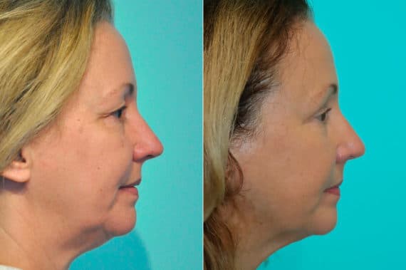 Before and after Skin Resurfacing by Dr. Shervin Naderi, Patient 17802