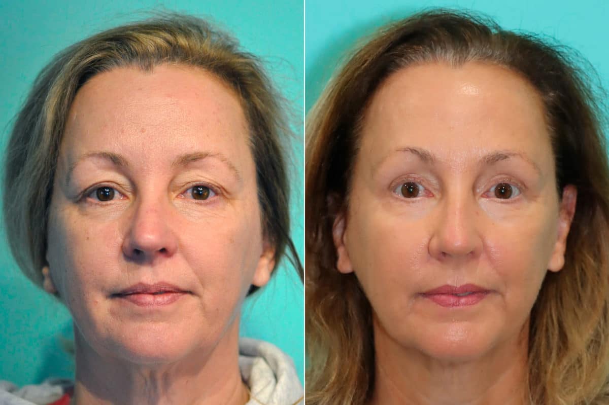 Before and after Skin Resurfacing by Dr. Shervin Naderi, Patient 17802