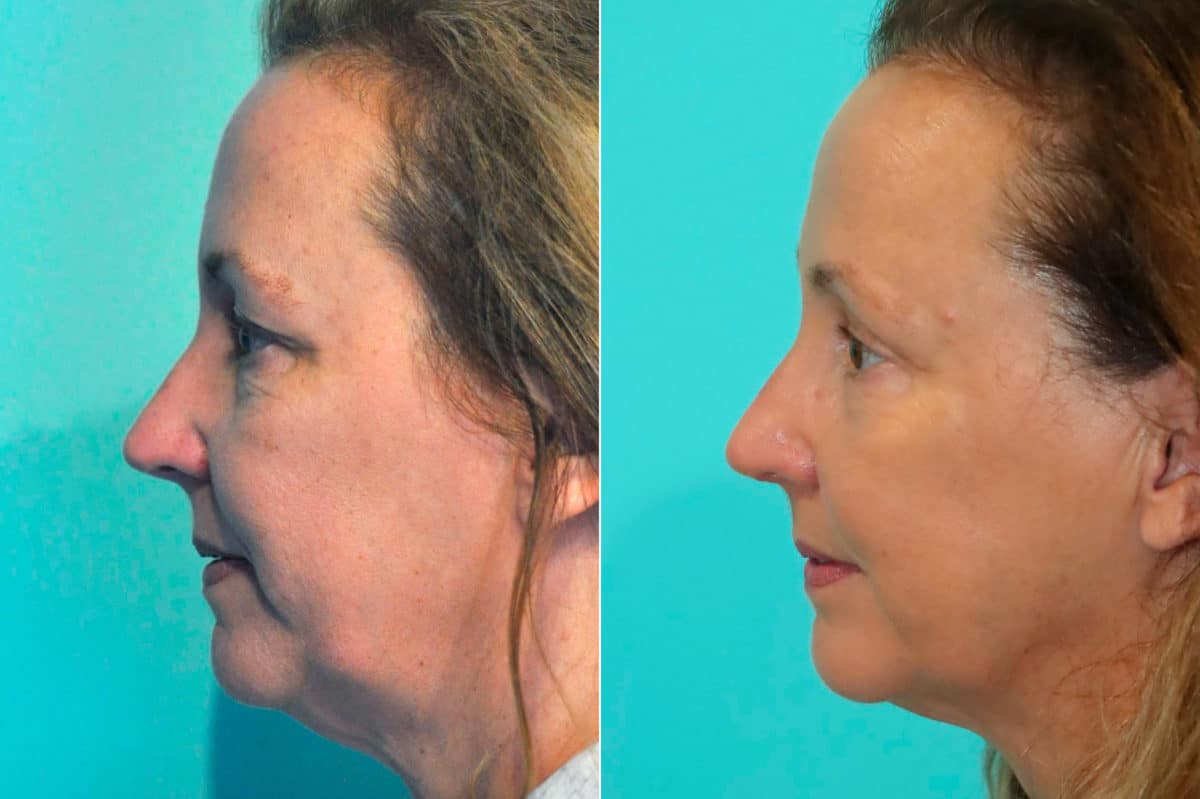 Before and after Skin Resurfacing by Dr. Shervin Naderi, Patient 17802