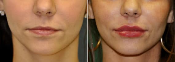 Before and after Injections by Dr. Shervin Naderi, Patient 11911