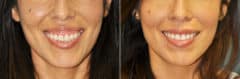 Before and after Botox Injections by Dr. Shervin Naderi, Patient 11918