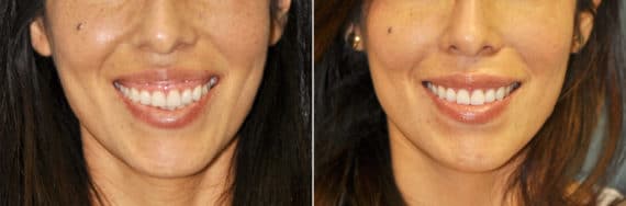 Before and after Botox Injections by Dr. Shervin Naderi, Patient 11918