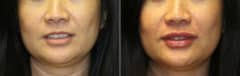 Before and after Injections by Dr. Shervin Naderi, Patient 12015