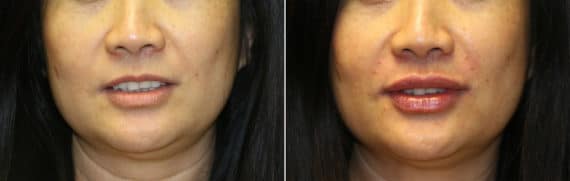 Before and after Injections by Dr. Shervin Naderi, Patient 12015