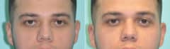 Before and after Injections by Dr. Shervin Naderi, Patient 12138