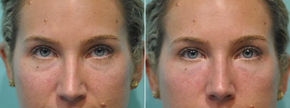 Before and after Injections by Dr. Shervin Naderi, Patient 12159