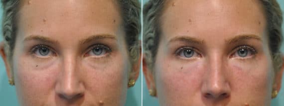 Before and after Injections by Dr. Shervin Naderi, Patient 12159