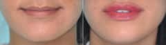 Before and after Injections by Dr. Shervin Naderi, Patient 12171