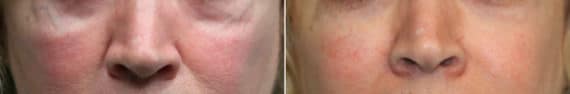 Before and after Injections by Dr. Shervin Naderi, Patient 13473