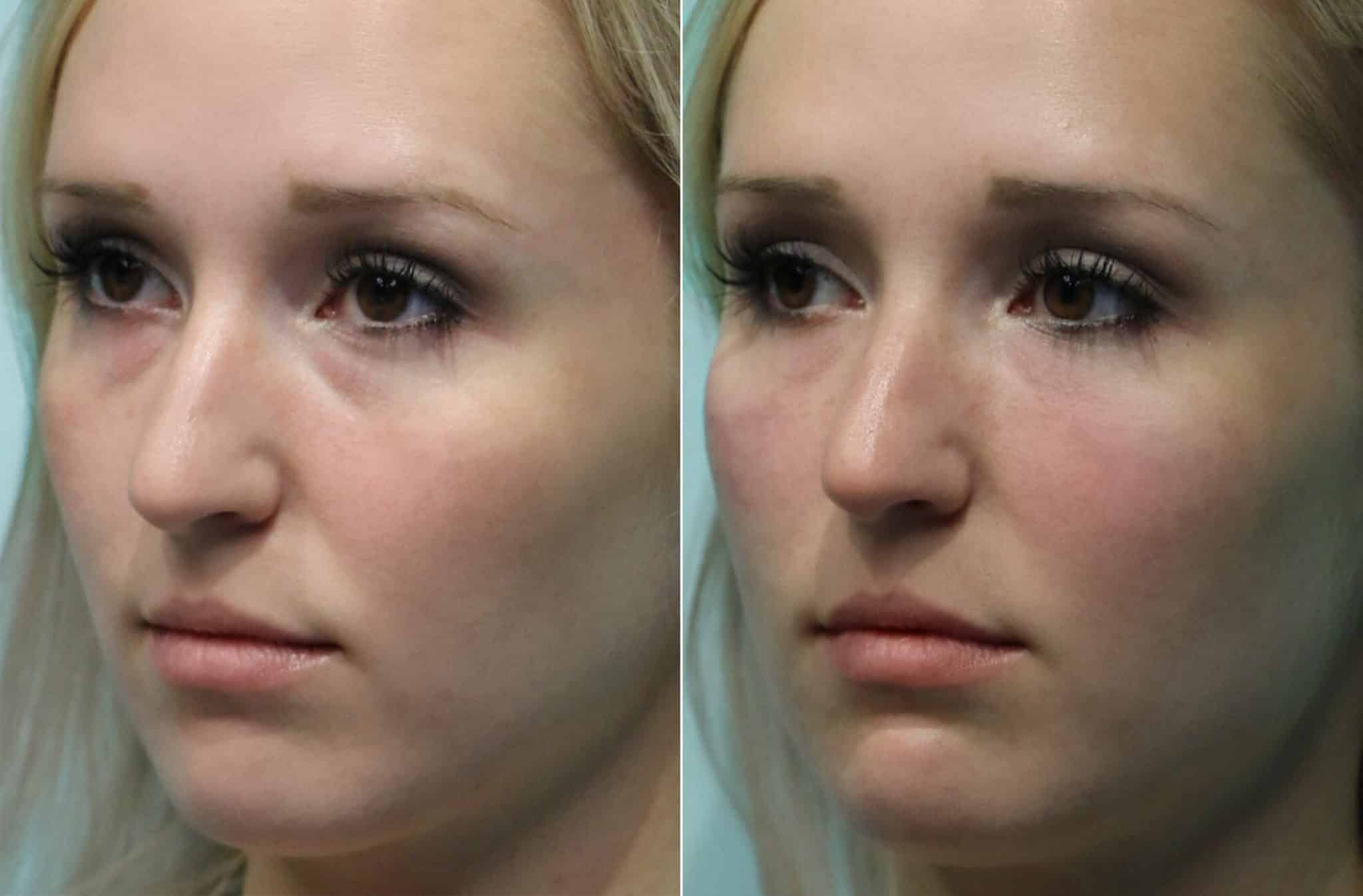 Injections, Tear Trough / Under Eye Injections photos Chevy Chase, MD
