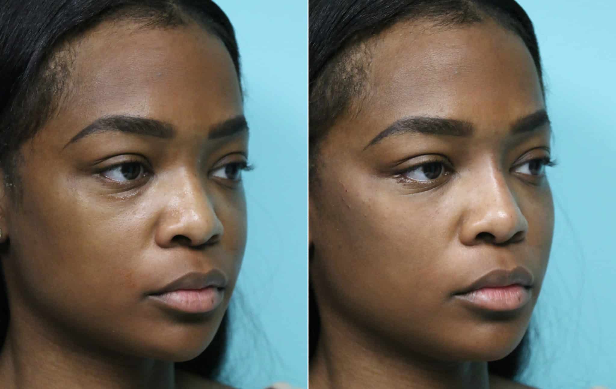Cheeks / Midface Injections, Injections, Tear Trough / Under Eye