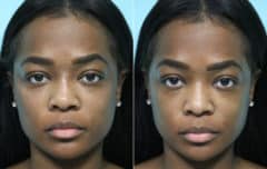 Before and after Cheeks / Midface Injections by Dr. Shervin Naderi, Patient 15736