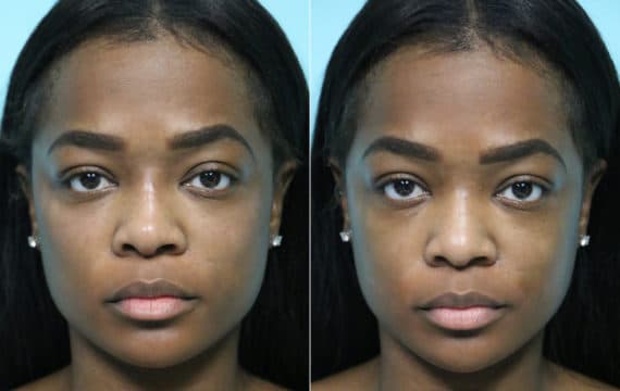 Cheeks / Midface Injections before and after photos in Reston, VACheeks / Midface Injections Before and After Photos in Reston, VA