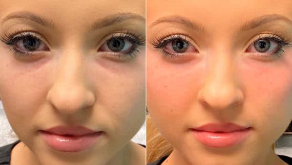 Tear Trough / Under Eye Injections before and after photos in Chevy Chase, MDTear Trough / Under Eye Injections Before and After Photos in Chevy Chase, MD