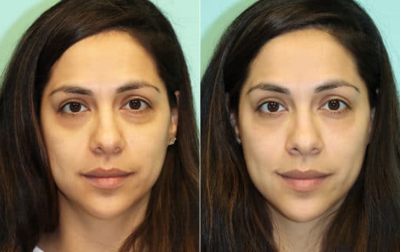 Before and after Injections by Dr. Shervin Naderi, Patient 16307